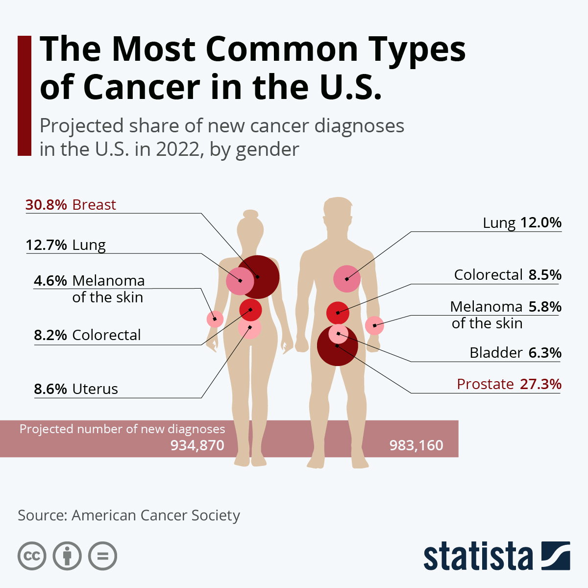 Infografía: Los tipos de cáncer más comunes en Estados Unidos |  Estadístico