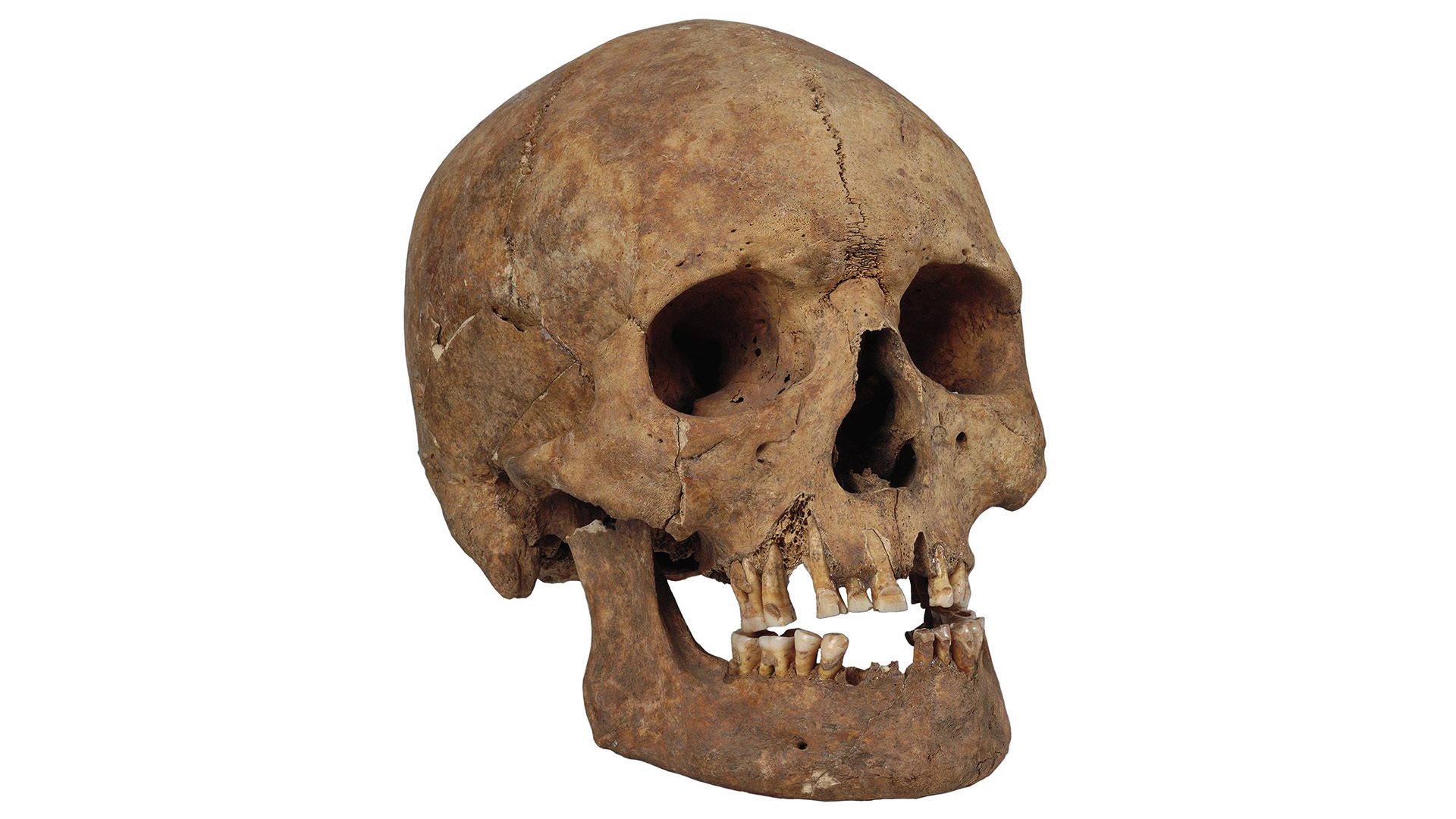 El cráneo de un hombre con dientes limados que fue enterrado en Gotland durante la época vikinga.