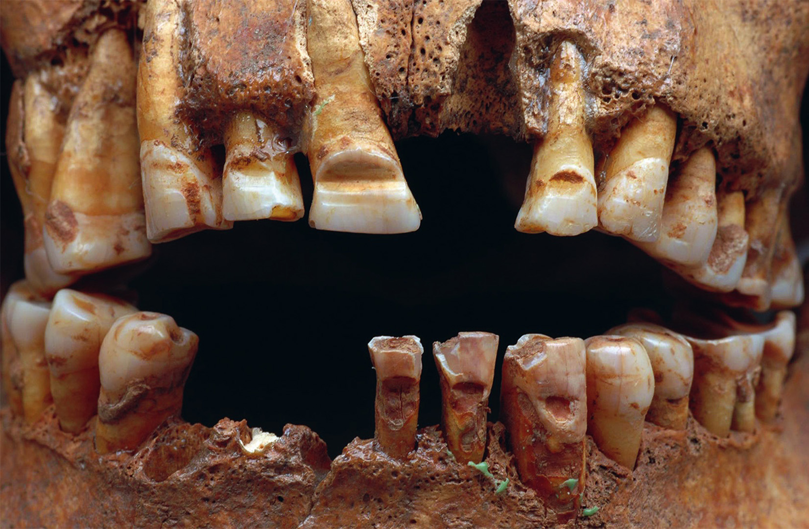 Detalle de cráneo que muestra surcos deliberados realizados en los dientes frontales.